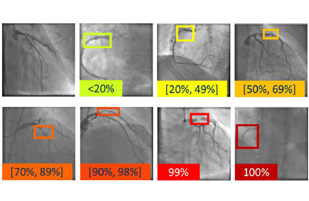 CADICA: Un avance en el diagnóstico de la enfermedad arterial coronaria con más de 6.000 imágenes accesibles